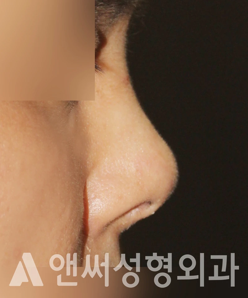 Answer Plastic Surgery case 400: Before