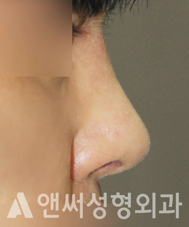 Answer Plastic Surgery case 400: After