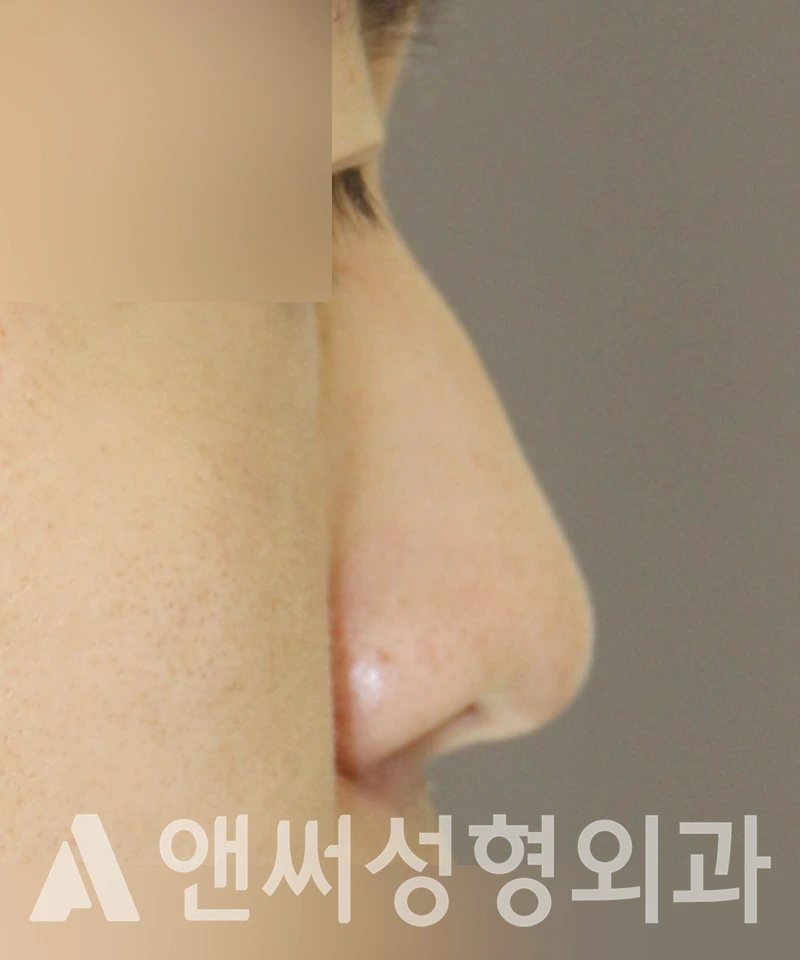 Answer Plastic Surgery case 398: Before