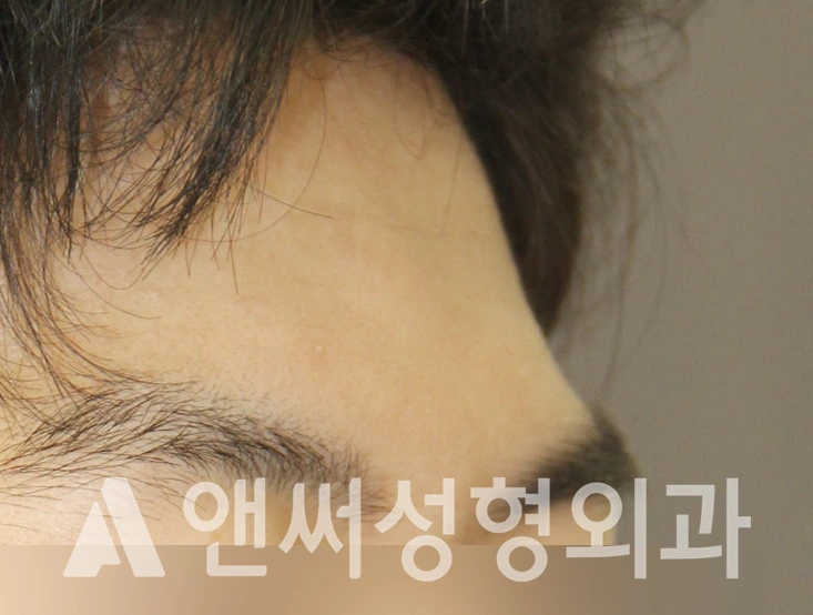 Answer Plastic Surgery case 395: Before