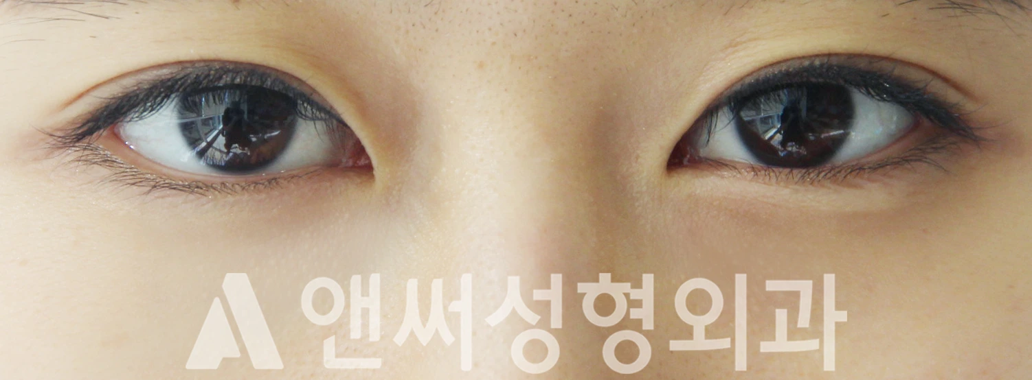 Answer Plastic Surgery case 394: Before