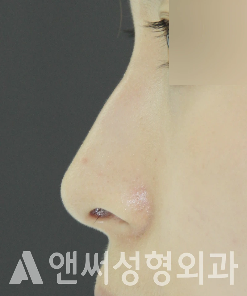 Answer Plastic Surgery case 393: Before