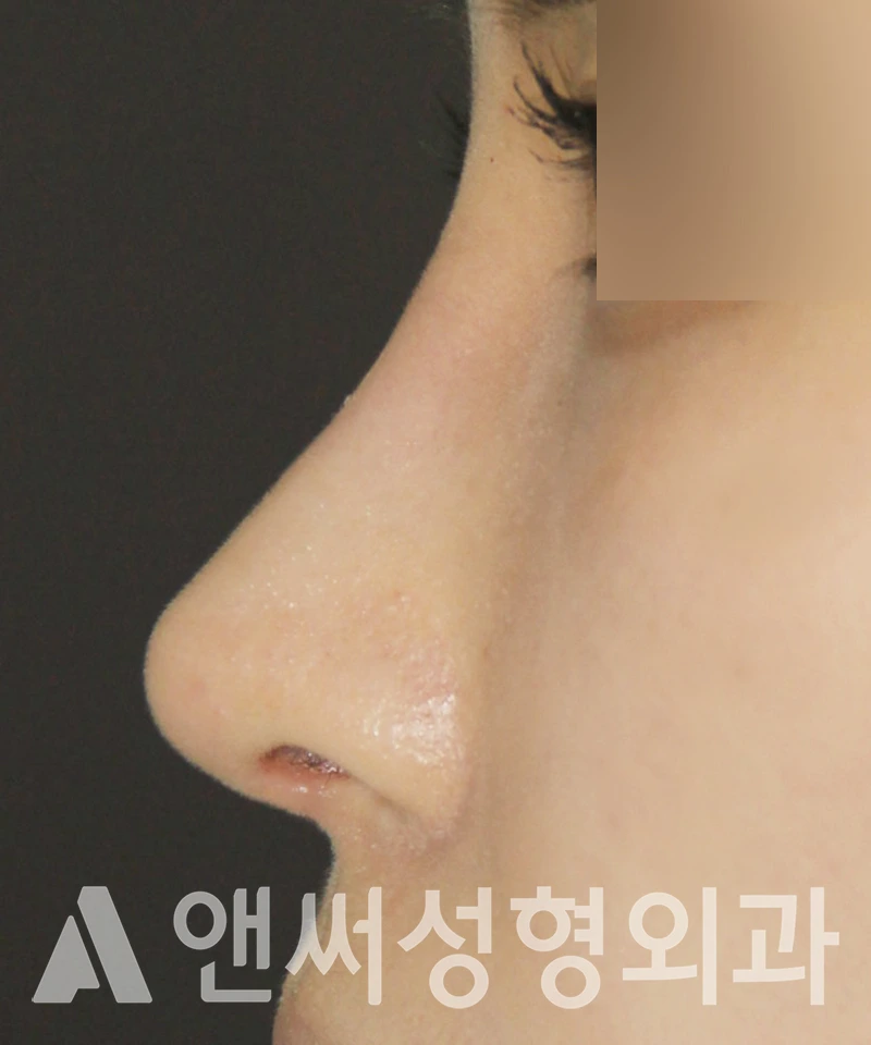 Answer Plastic Surgery case 393: After
