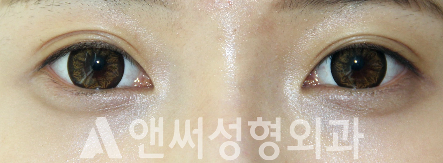 Answer Plastic Surgery case 392: Before