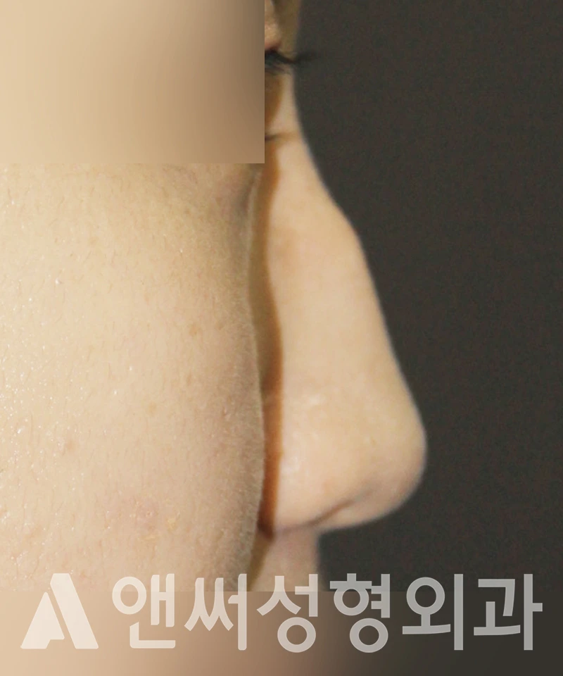 Answer Plastic Surgery case 390: Before