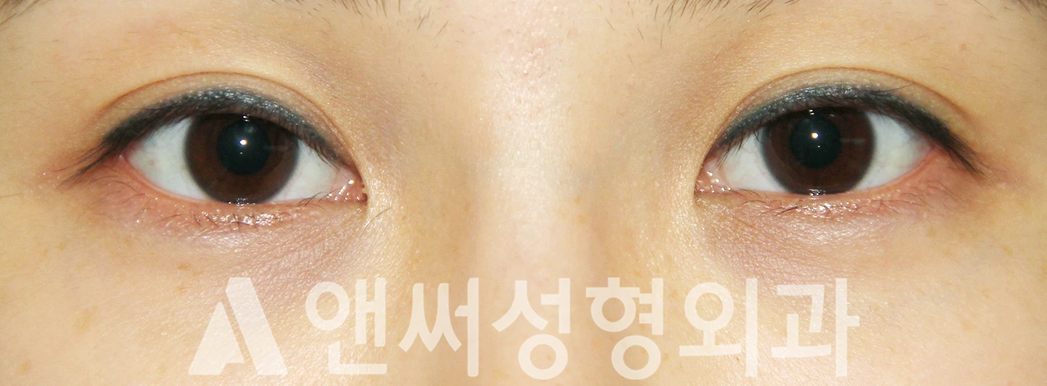 Answer Plastic Surgery case 388: Before