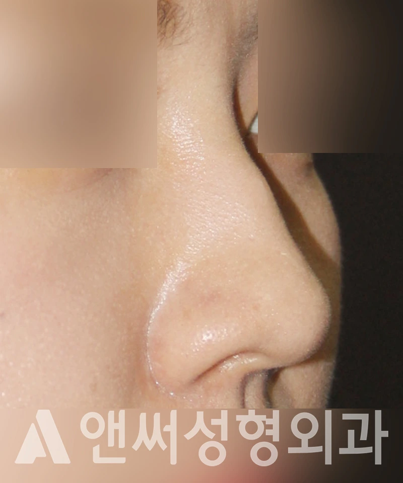 Answer Plastic Surgery case 387: Before