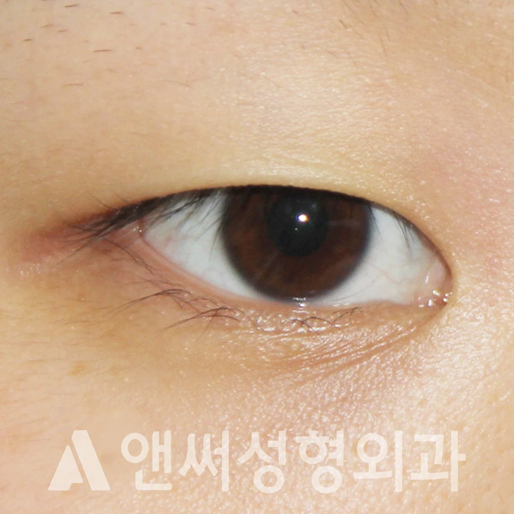 Answer Plastic Surgery case 386: Before