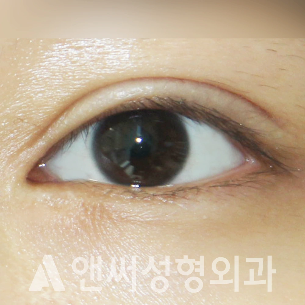 Answer Plastic Surgery case 385: Before