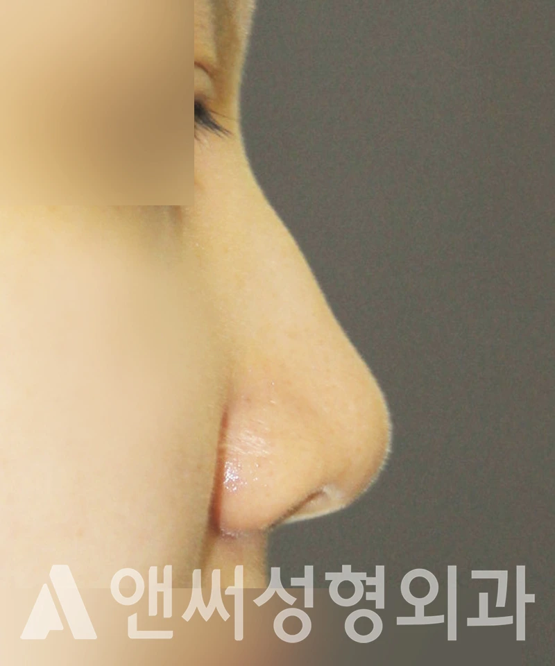 Answer Plastic Surgery case 383: Before