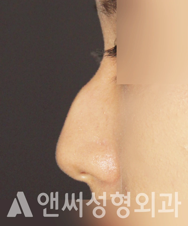 Answer Plastic Surgery case 382: Before