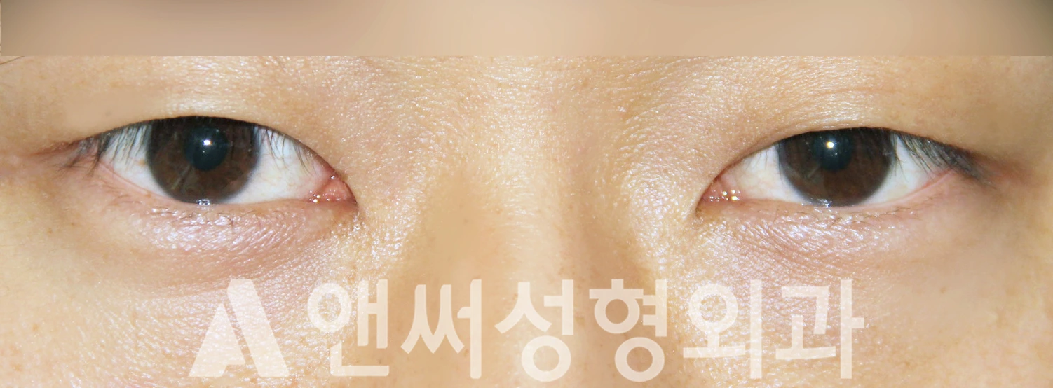 Answer Plastic Surgery case 379: Before