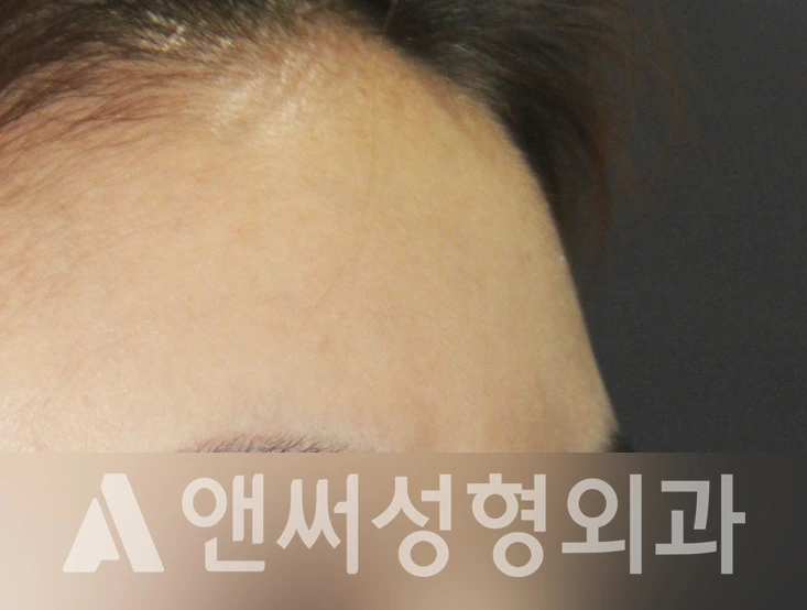 Answer Plastic Surgery case 378: Before