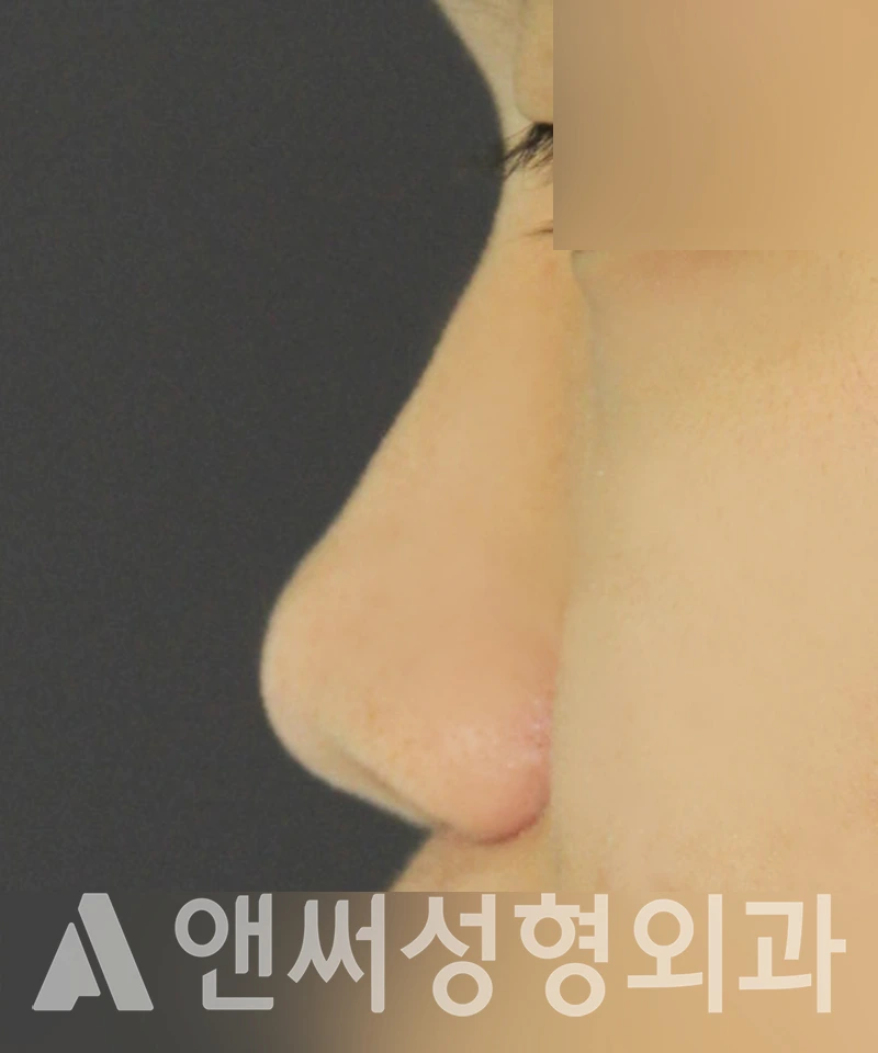 Answer Plastic Surgery case 376: Before