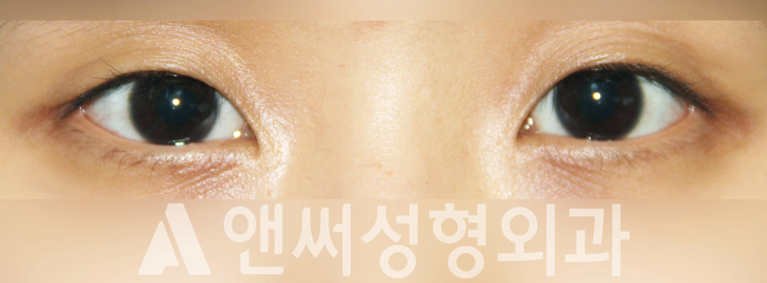 Answer Plastic Surgery case 375: Before