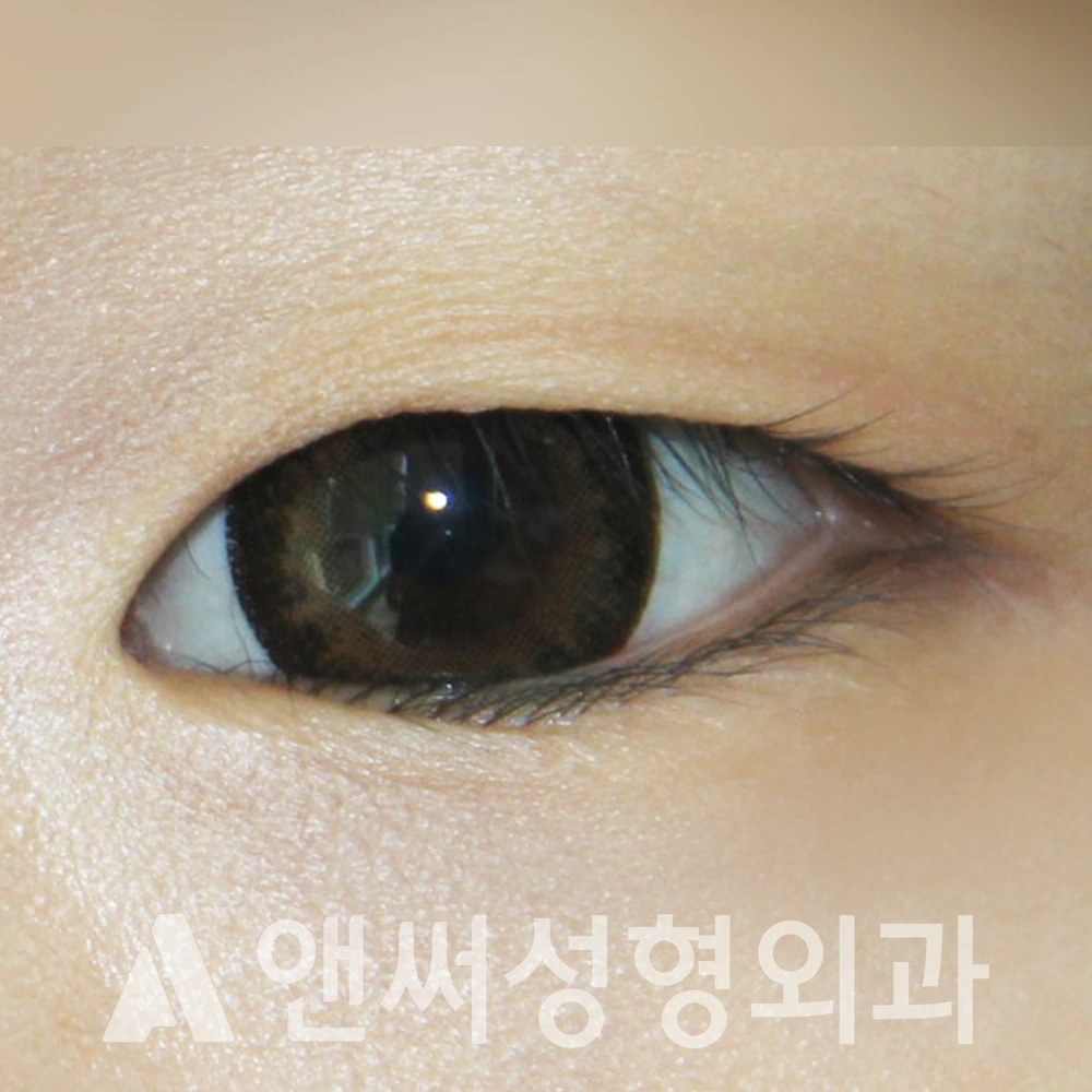 Answer Plastic Surgery case 374: Before