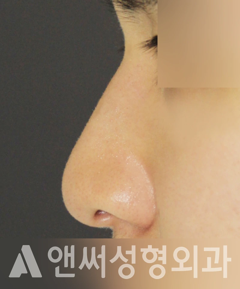 Answer Plastic Surgery case 373: Before