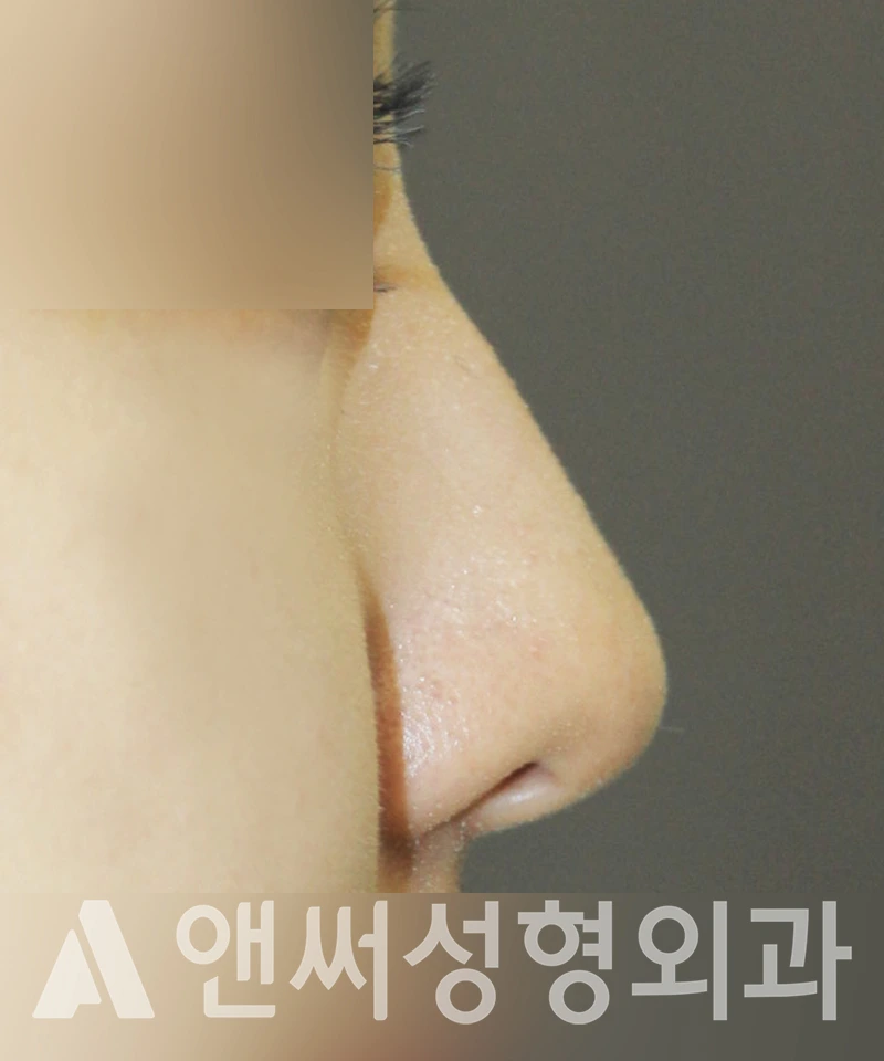 Answer Plastic Surgery case 372: Before