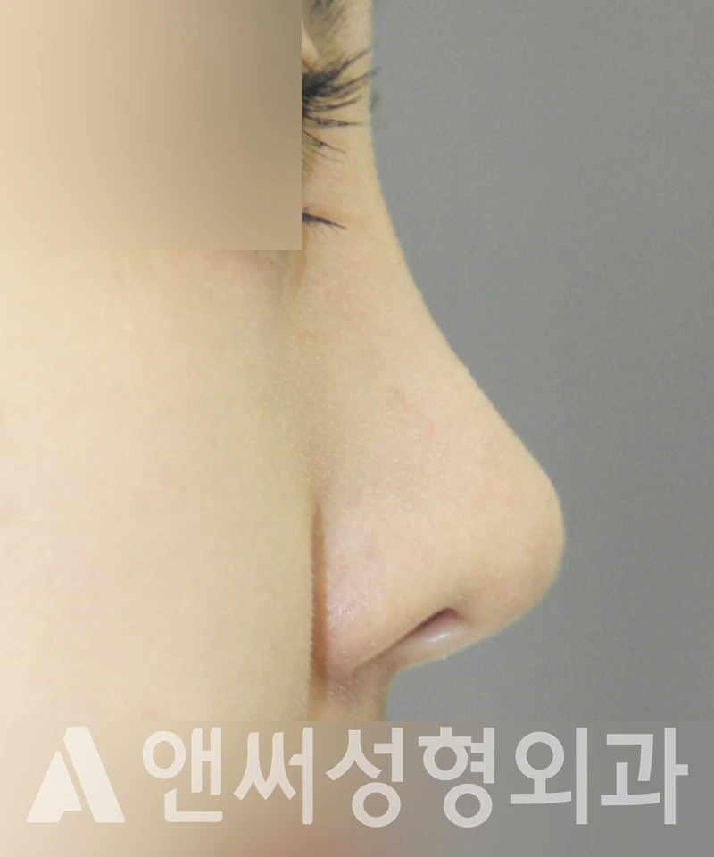 Answer Plastic Surgery case 372: After