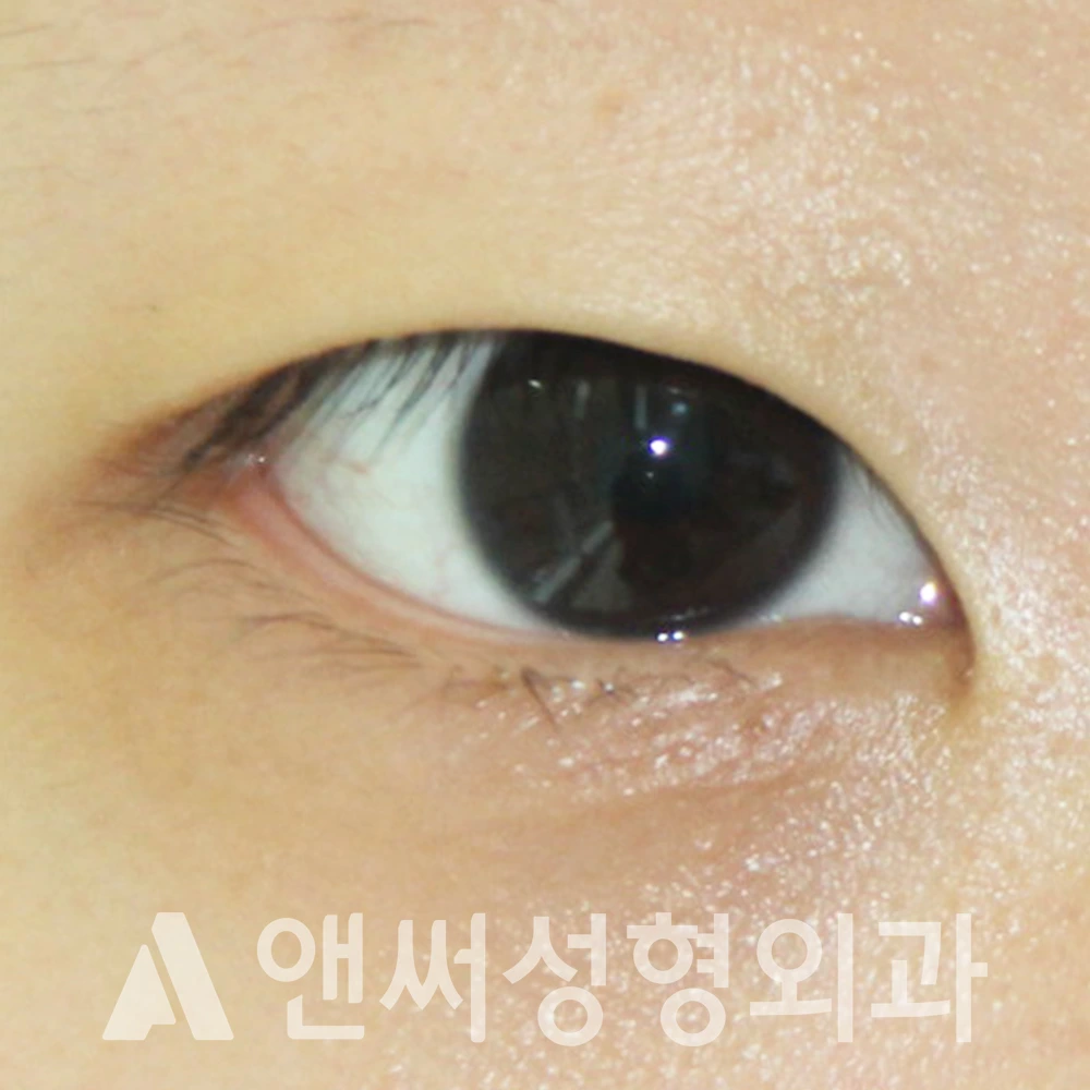Answer Plastic Surgery case 371: Before