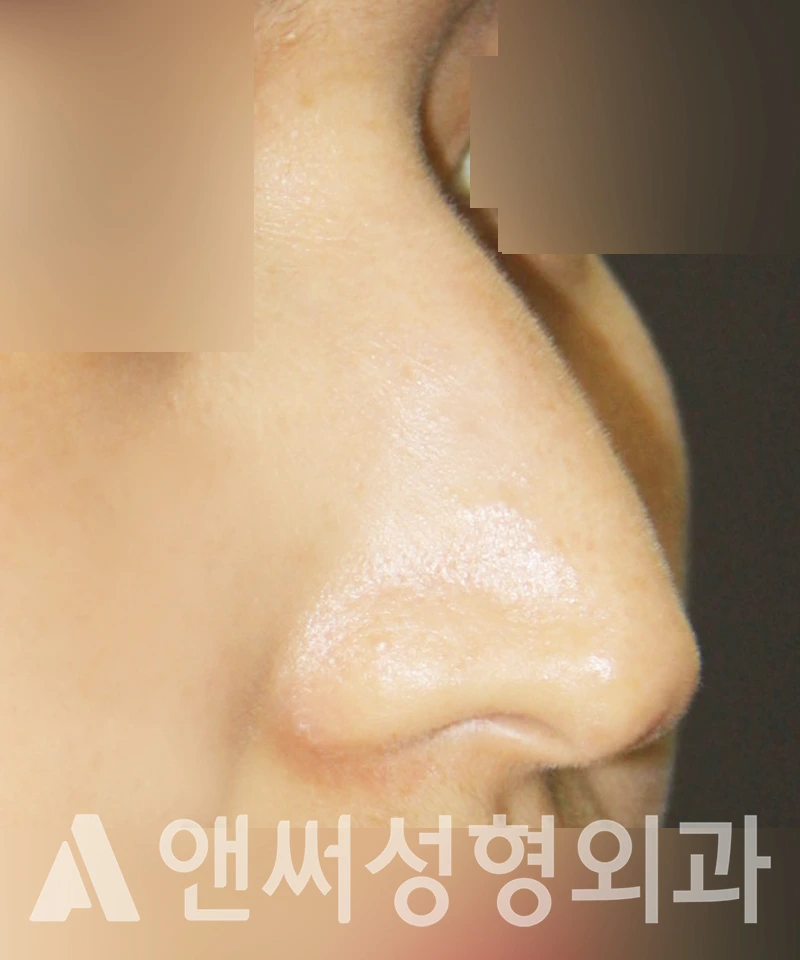 Answer Plastic Surgery case 370: Before