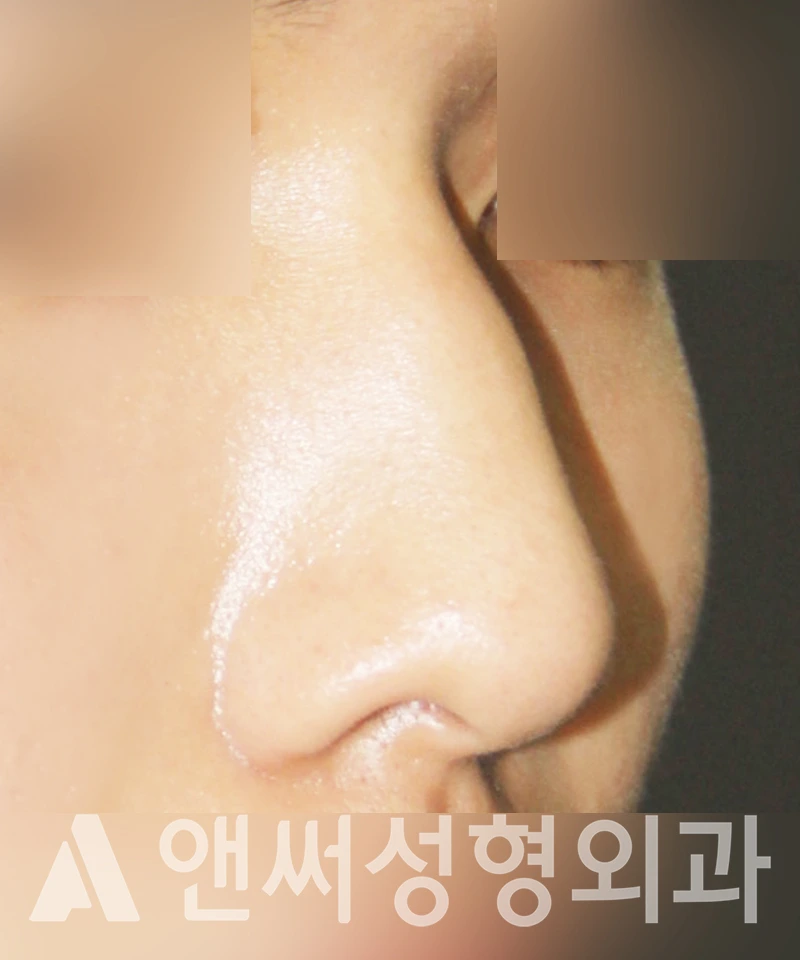 Answer Plastic Surgery case 369: Before