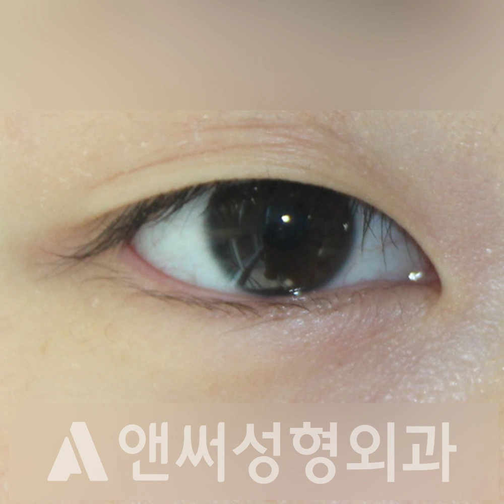 Answer Plastic Surgery case 368: Before