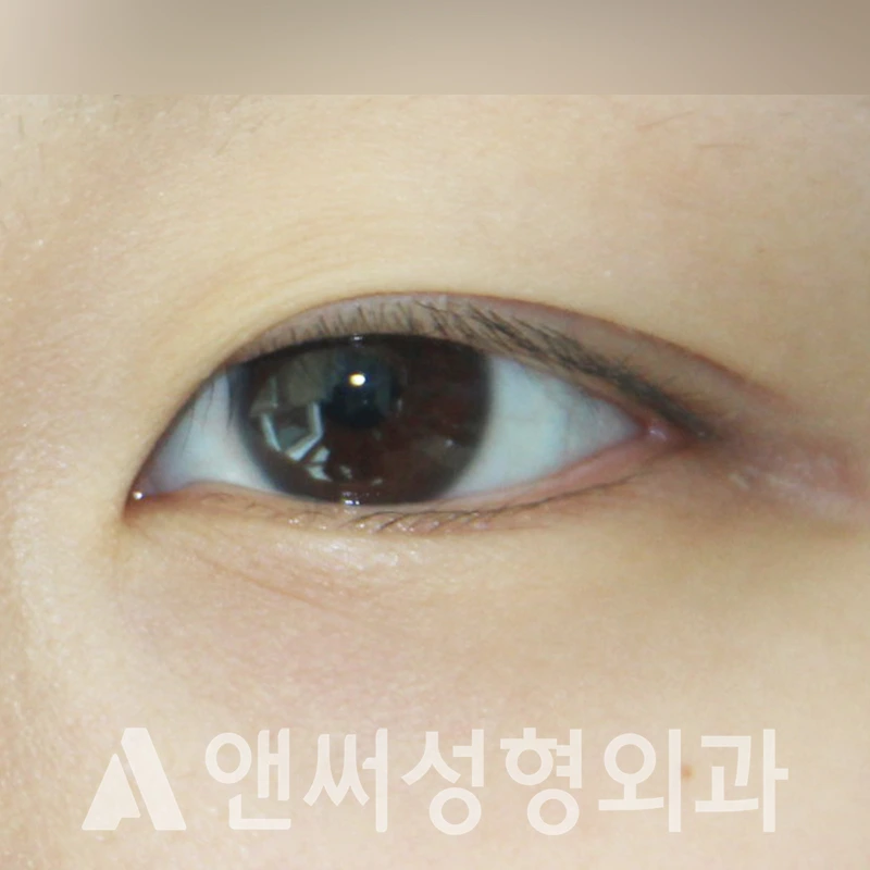 Answer Plastic Surgery case 366: Before