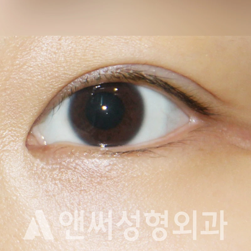 Answer Plastic Surgery case 366: After