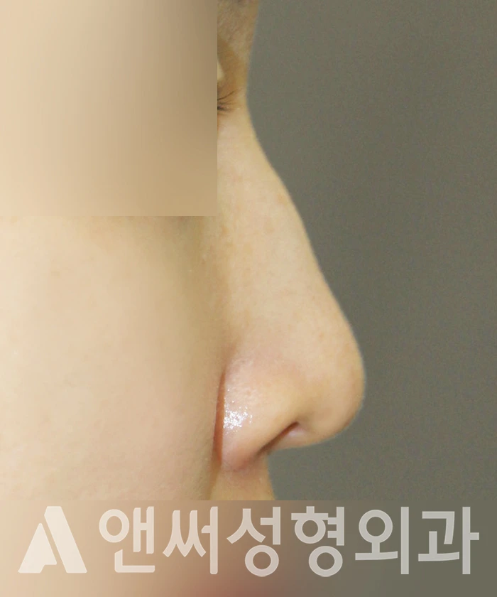 Answer Plastic Surgery case 365: Before