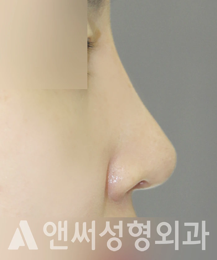 Answer Plastic Surgery case 365: After