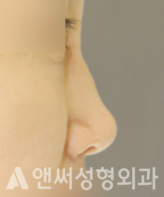 Answer Plastic Surgery case 364: Before