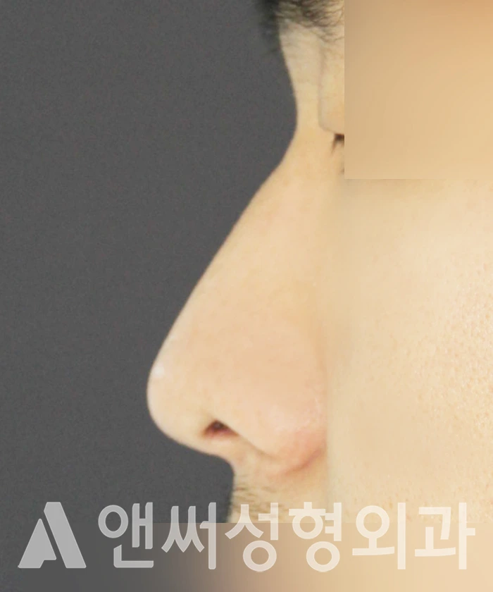Answer Plastic Surgery case 363: Before