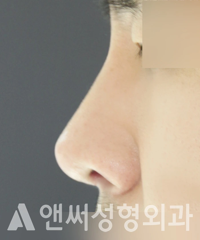 Answer Plastic Surgery case 363: After