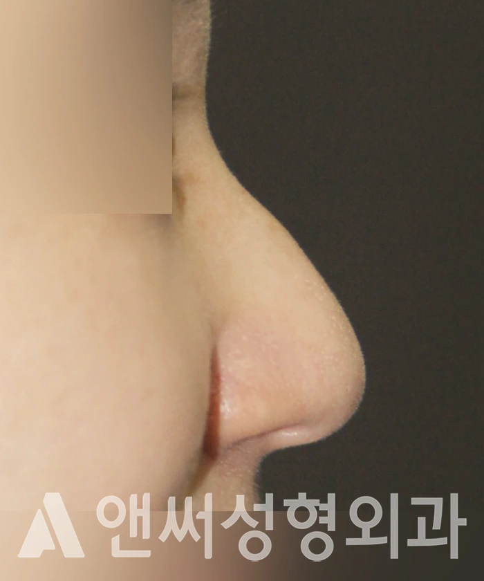 Answer Plastic Surgery case 361: Before