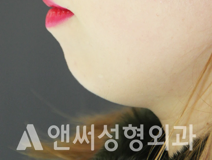 Answer Plastic Surgery case 360: Before