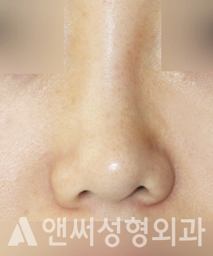 Answer Plastic Surgery case 319: Before