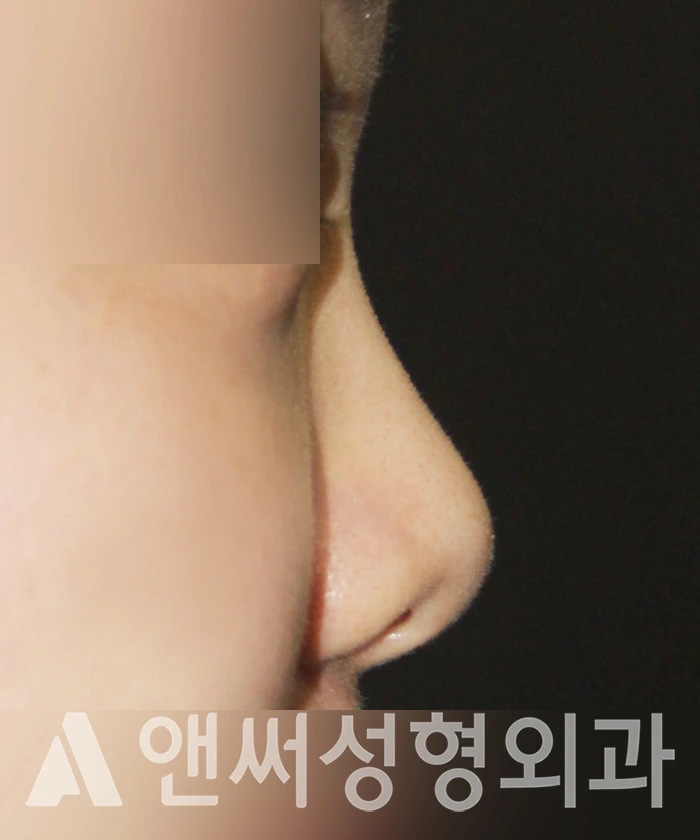 Answer Plastic Surgery case 358: Before