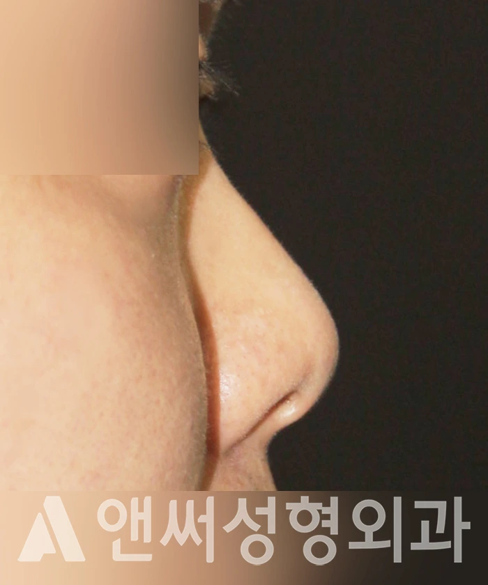 Answer Plastic Surgery case 356: Before
