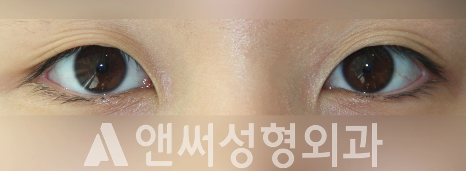 Answer Plastic Surgery case 355: Before