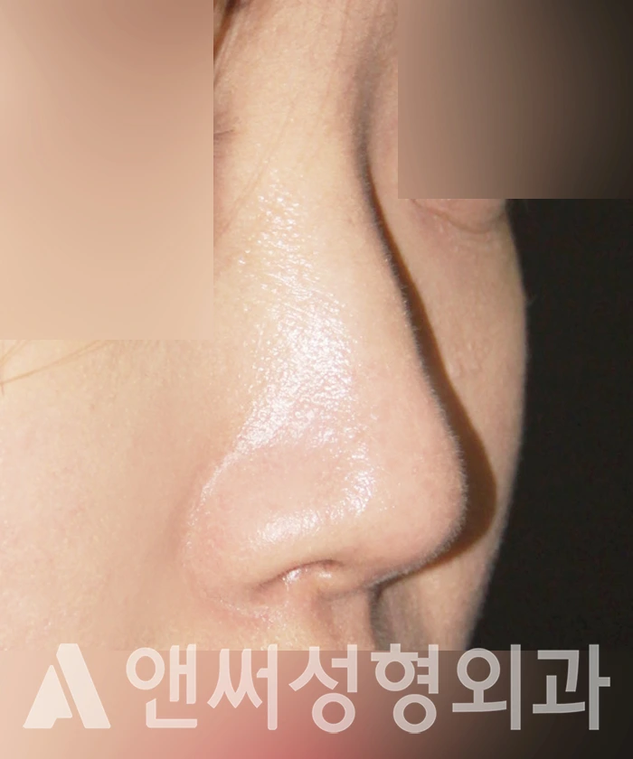 Answer Plastic Surgery case 354: Before