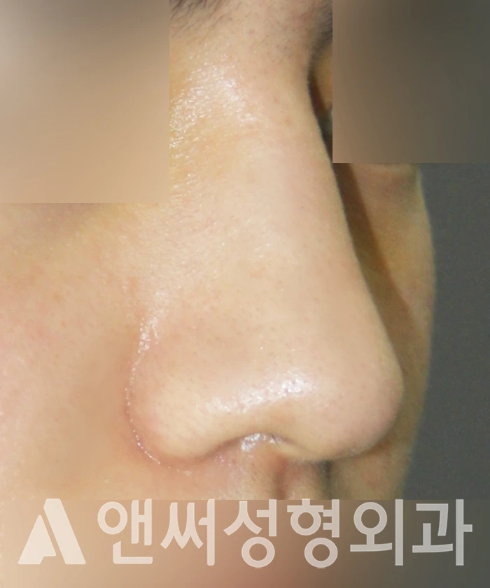 Answer Plastic Surgery case 353: Before