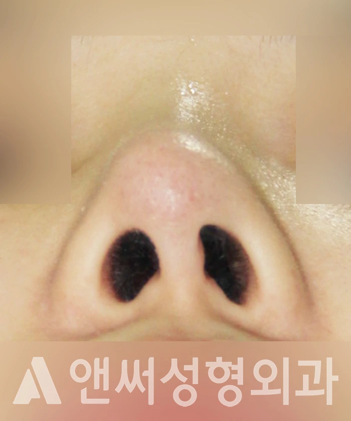 Answer Plastic Surgery case 352: Before