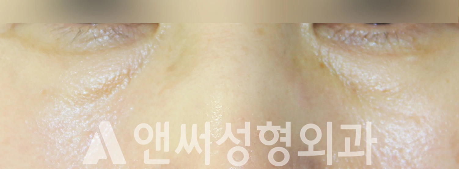 Answer Plastic Surgery case 351: Before
