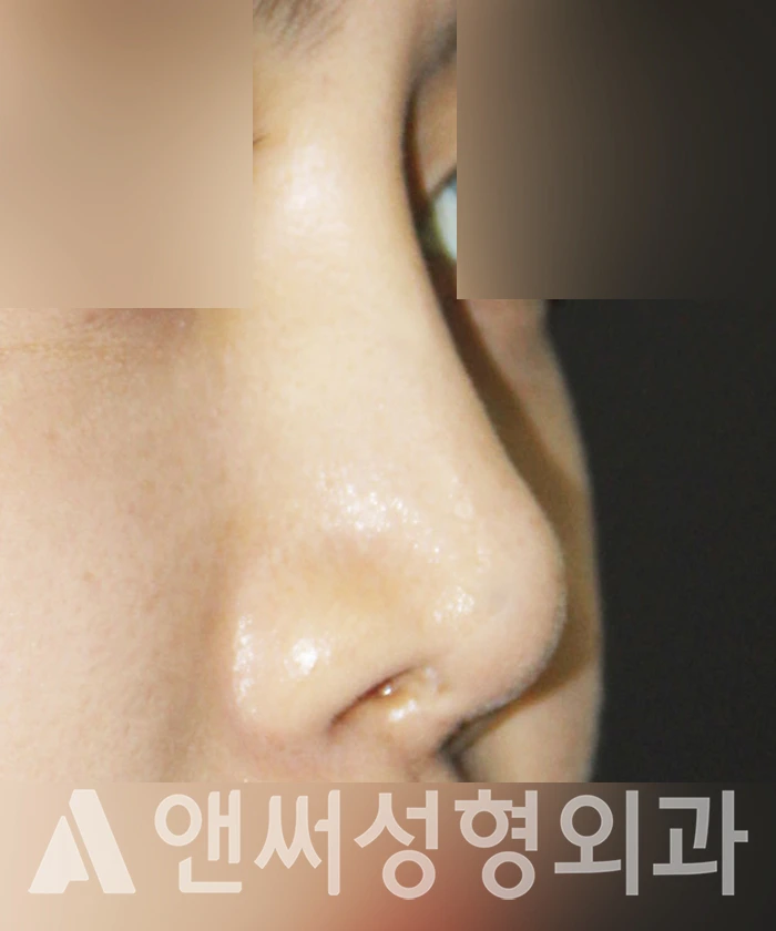 Answer Plastic Surgery case 350: Before