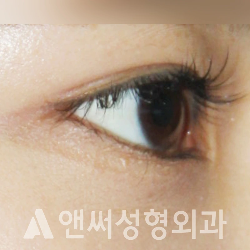 Answer Plastic Surgery case 349: Before