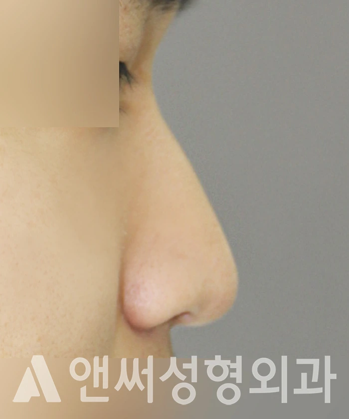 Answer Plastic Surgery case 348: Before