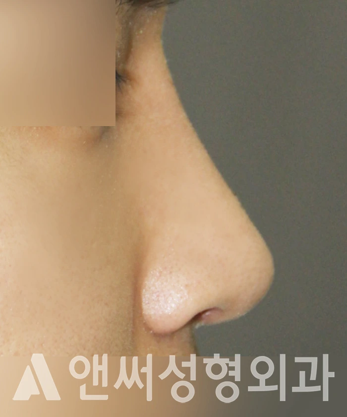Answer Plastic Surgery case 348: After