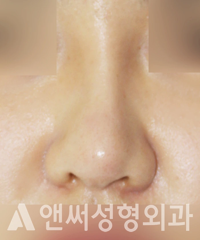 Answer Plastic Surgery case 347: Before
