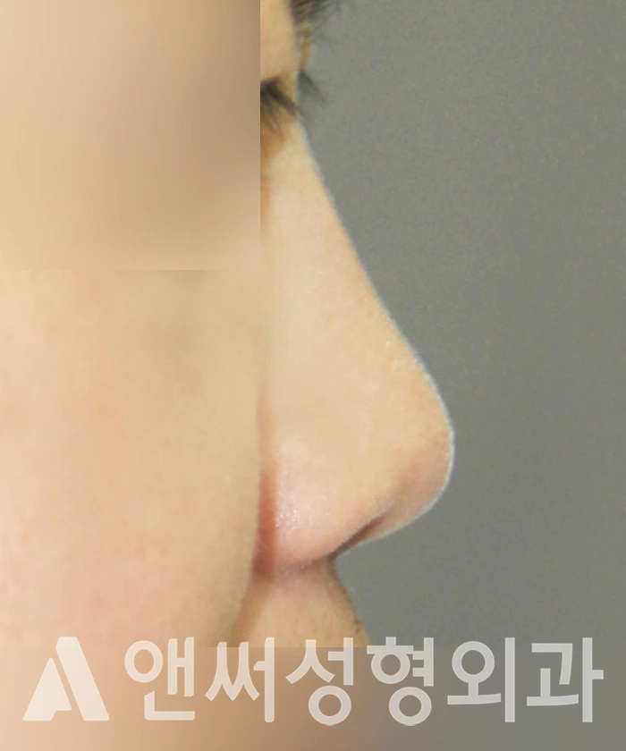 Answer Plastic Surgery case 346: Before